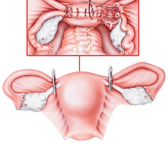 abdominal hysterectomy