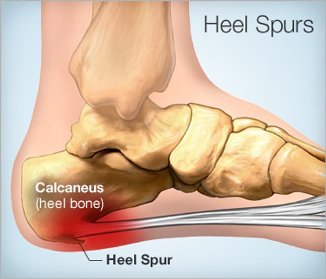 Heel Spur & Plantar Fasciitis Surgery | Heel Pain Treatments - YouTube