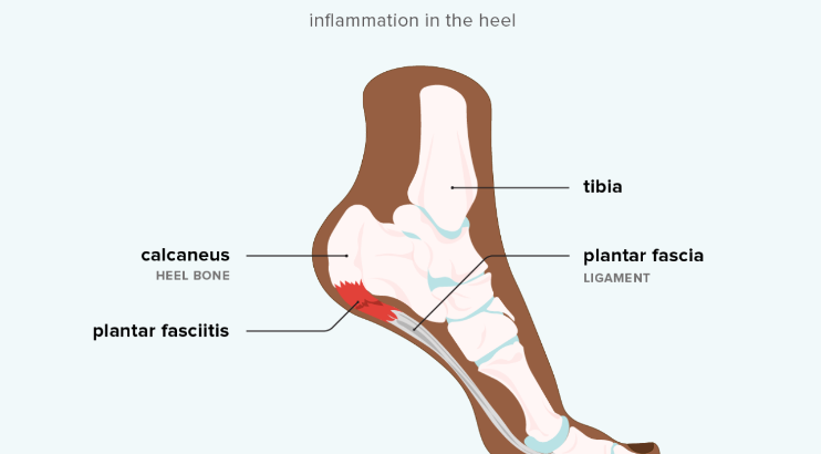 How can orthotics help my bunions? -